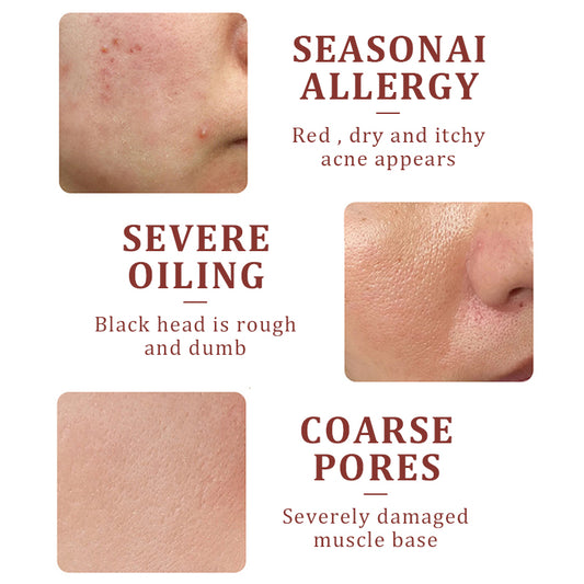 Afcare Calendula Acne Reducing Serum with Salicylic Acid